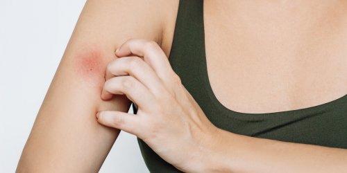 Recrudescence des piqures de taon : "Mon medecin m-a donne ces conseils"