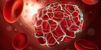 Embolie pulmonaire : quels sont ses symptomes, causes, traitements, signes et quelle est sa duree ?