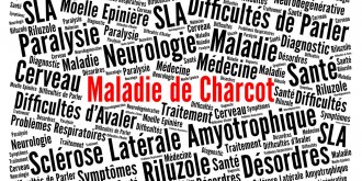 L’Inserm identifie un signe precurseur de la maladie de Charcot (SLA), visible des annees avant les symptomes moteurs