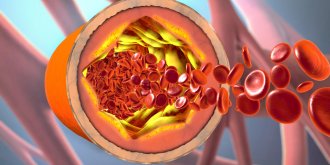 Quels sont les taux de bon (HDL) ou mauvais (LDL) cholesterol, ses symptomes et traitements ? 