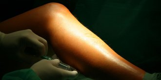 Operation des varices : la convalescence