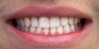Les femmes ayant perdu des dents sont plus a risque d’hypertension arterielle