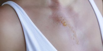 Faut-il percer une cloque de brulure ?