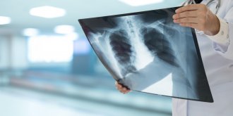 Tuberculose : 2 nouveaux antibiotiques, moins toxiques, arrivent sur le marche 