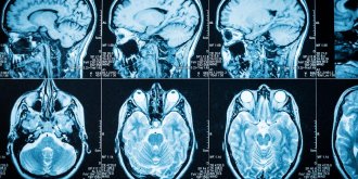 Lymphome non hodgkinien : le lymphome cerebral
