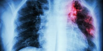 Mucoviscidose : causes, traitements et pistes de recherche