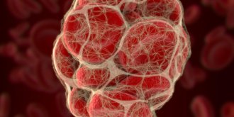 Embolie pulmonaire : le traitement anticoagulant