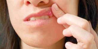 Aphte sur la langue : symptomes, causes, solutions