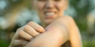 Abeille, tique, araignee… Un pharmacien explique comment savoir quel insecte vous a mordu ou pique