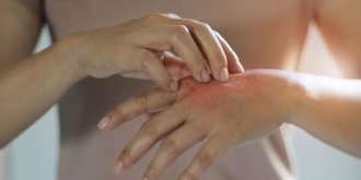Œdeme : 7 astuces contre les mains qui gonflent