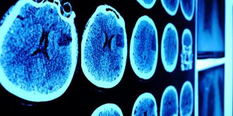 Mastoidite (inflammation de la mastoide) : symptomes et traitements 