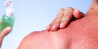 8 remedes naturels anti coup de soleil