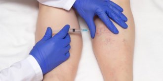 Traitement des varices : 8 effets indesirables a surveiller, selon l-ANSM