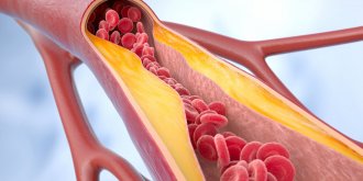 Atherosclerose : sept leviers pour prevenir une maladie cardiovasculaire silencieuse