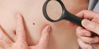 Cancer de la peau : 4 photos qui doivent alerter