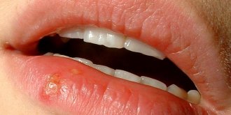 Herpes genital, labial, oculaire : symptomes et comment le soigner