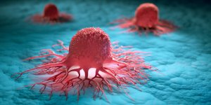 Cancer : reduire de 10 % les aliments ultra-transformes diminue les risques