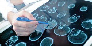 Parkinson : un test de depistage en 6 minutes !
