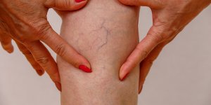 Phlebite et varice : quelles differences ?