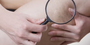 Varices : les signes qui doivent alerter