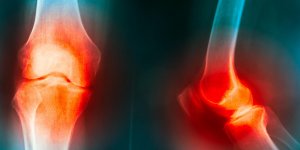 Arthrose du genou : l-harpagophytum comme traitement naturel