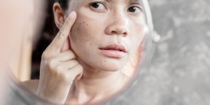 Taches brunes : causes, dangers, traitements... Tout pour les eliminer 
