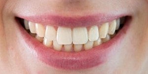 Comment stopper l’erosion dentaire