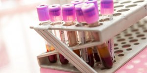 Trop de cholesterol : l-hypercholesterolemie