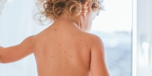 Les maladies infantiles qui causent des boutons chez bebe