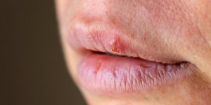 Deux personnes decedent du virus de l’herpes apres un don de rein 