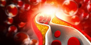 Trop de cholesterol : quelles maladies risque-t-on ?
