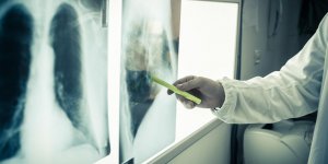 Metastase pulmonaire : le cancer secondaire du poumon
