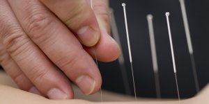 Declenchement naturel de l-accouchement : l-acupuncture efficace ?
