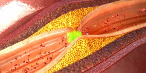 Atherosclerose : le diagnostic par angiographie