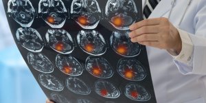 AVC : les tests qui permettent de predire le risque