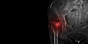 Les fumeurs plus a risque de souffrir d-une fracture de la hanche