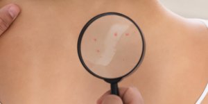 Demangeaison cutanee : reconnaitre des boutons d-allergie