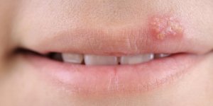 Herpes labial : comment faire disparaitre un bouton de fievre pendant la nuit