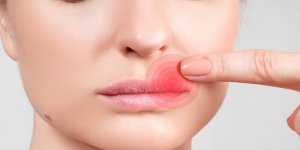 Herpes labial : 3 remedes de grands-meres anti bouton de fievre