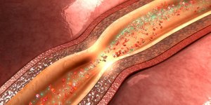 Atherosclerose : quels sont les traitements ?