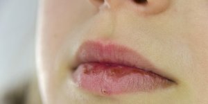 Bouton de fievre et grossesse : un remede
