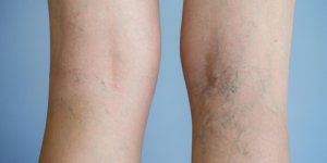 Operation des varices : les complications