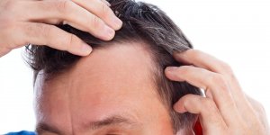 Elle decouvre par erreur une solution contre la calvitie