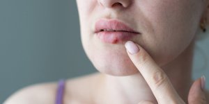 Bouton d-herpes : les huiles essentielles efficaces