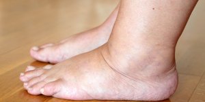 Pieds gonfles : les signes qui doivent vous alarmer