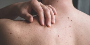 Cancer de la peau : les differentes formes a (re)connaitre