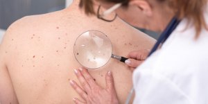 Melanome : le cancer qui touche de plus en plus d’hommes
