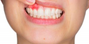 Gencives qui saignent : 6 conseils pour en finir