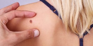 Angiome senile : un signe de cancer de la peau ?