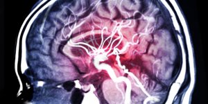 Son AVC a 33 ans lui a "fait perdre des millions de neurones"
